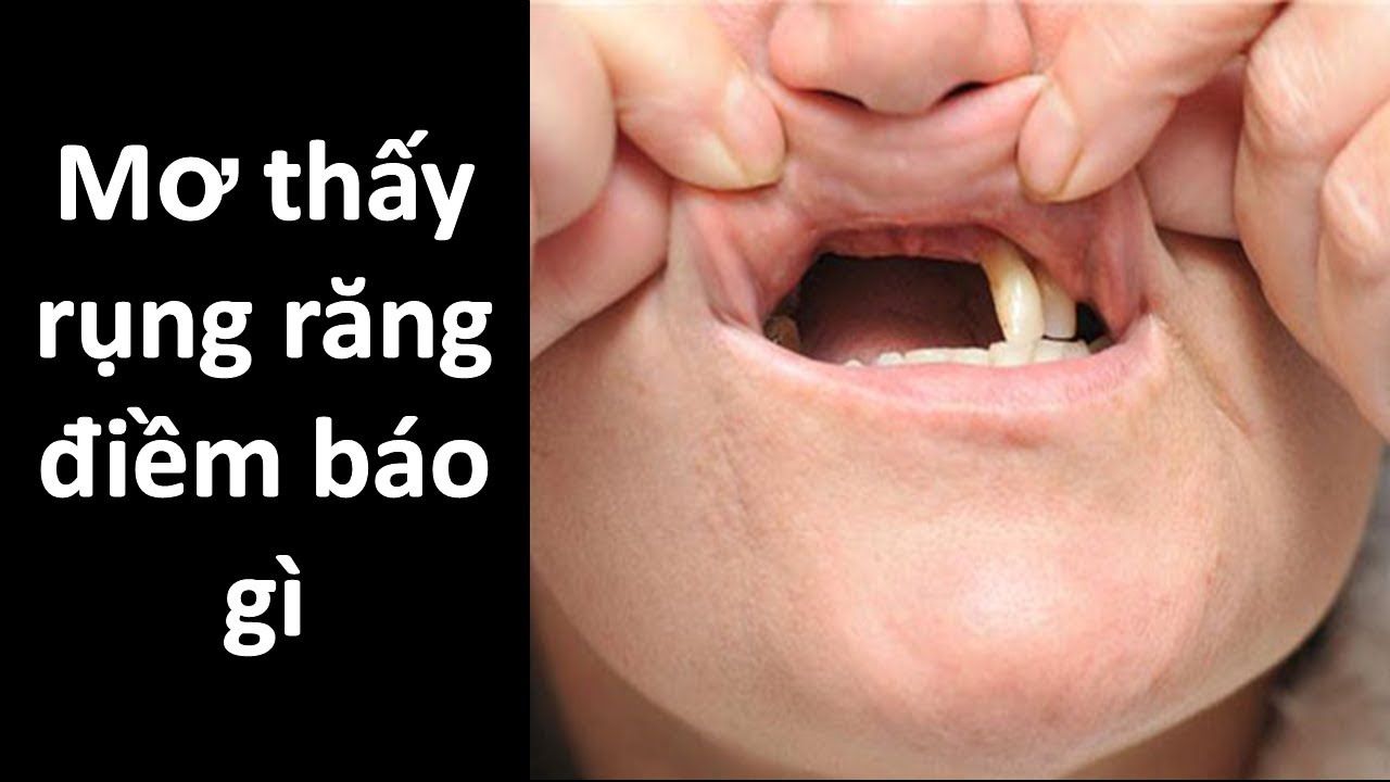 Điềm báo mơ rụng răng, Giải mã điềm lãnh hay điền dữ?